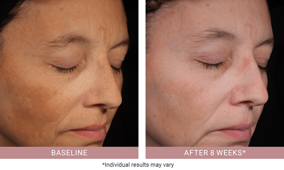 Eucerin Anti Pigment With Patented Thiamidol eucerin-anti-pigment-with-patented-thiamidol